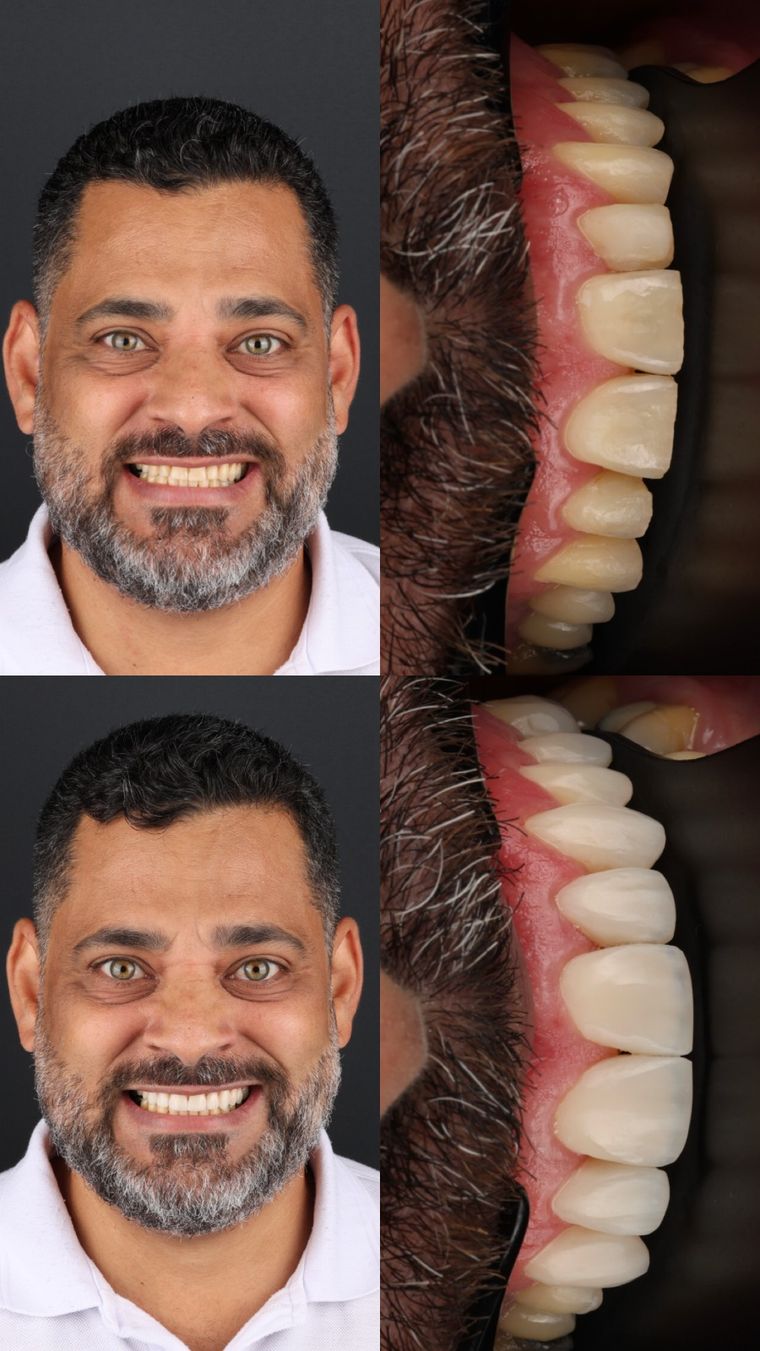 Caso real: antes e depois de facetas em resina, com detalhe dos dentes