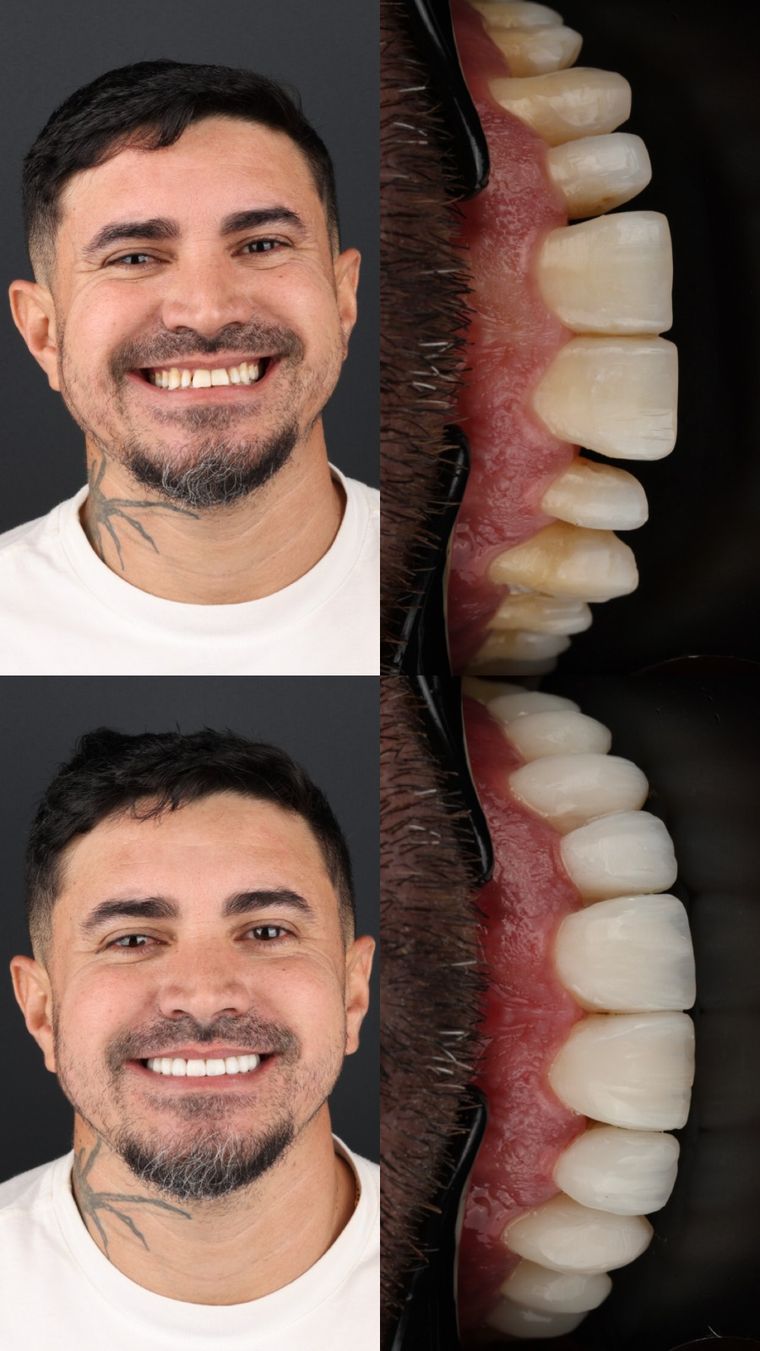 Caso real: antes e depois de facetas em resina, com detalhe dos dentes