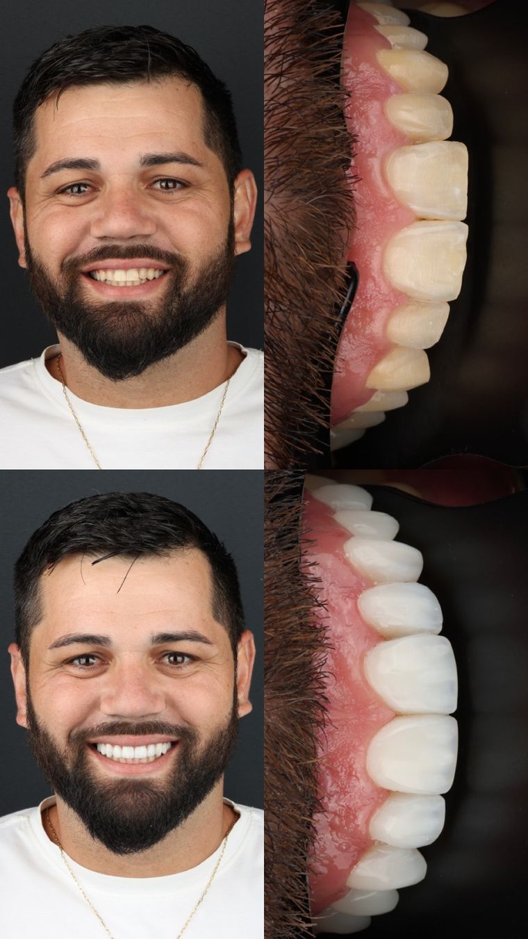 Caso real: antes e depois de facetas em resina, com detalhe dos dentes