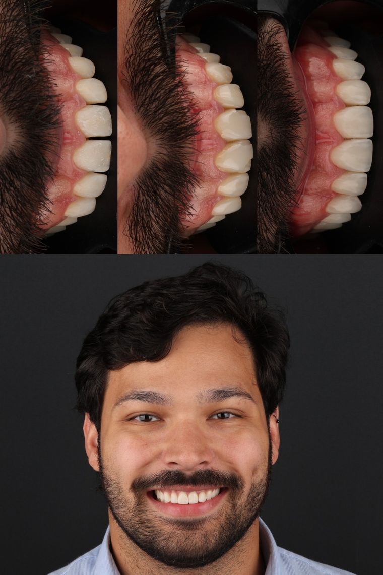 Caso real: detalhes do sorriso e resultado final em facetas de resina