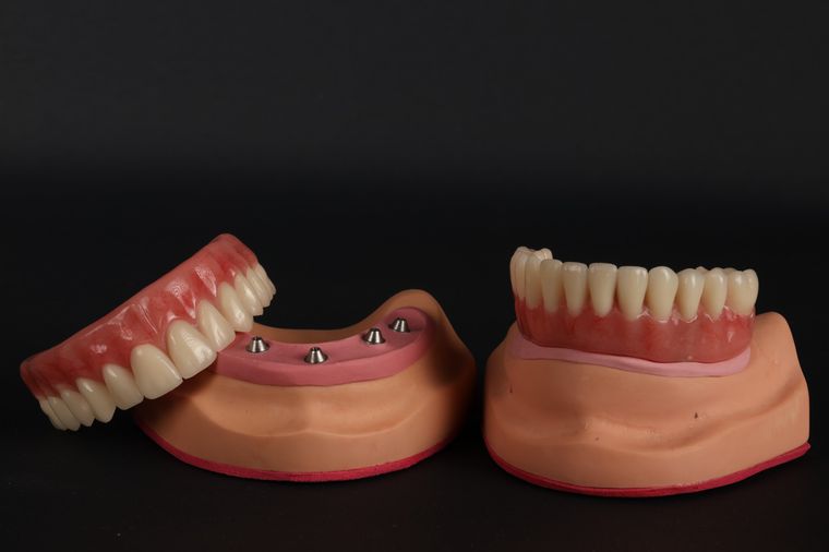 Prótese protocolo e modelo de planejamento sobre implantes