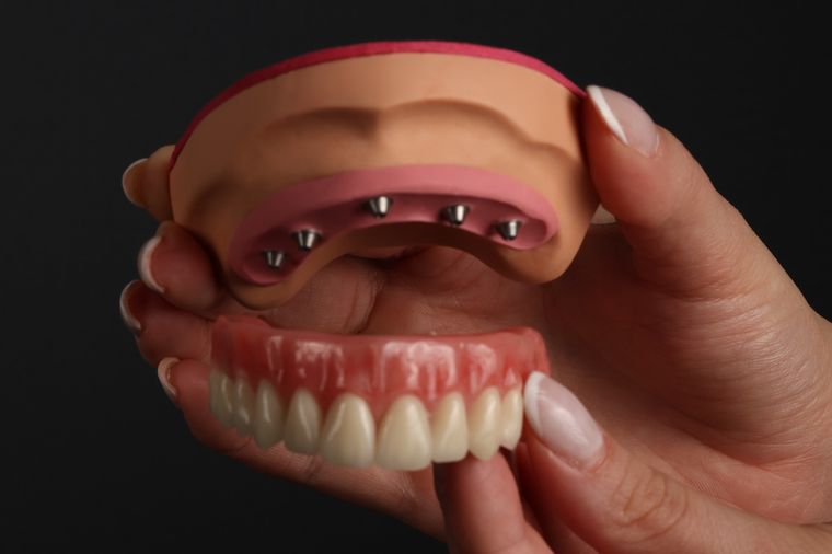 Prótese protocolo posicionada sobre os implantes